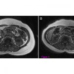 MRI Images Visceral Fat